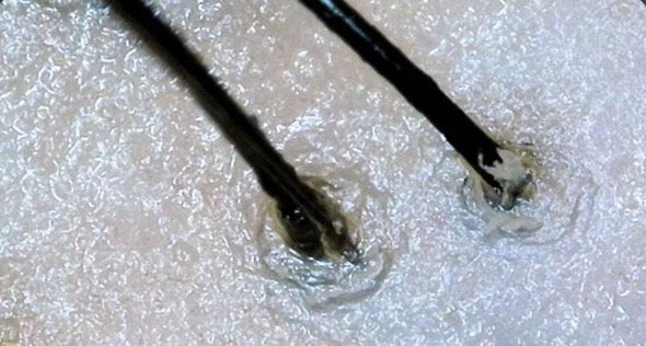Follicles